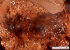 Панкреонекроз тяжелое заболевание поджелудочной железы